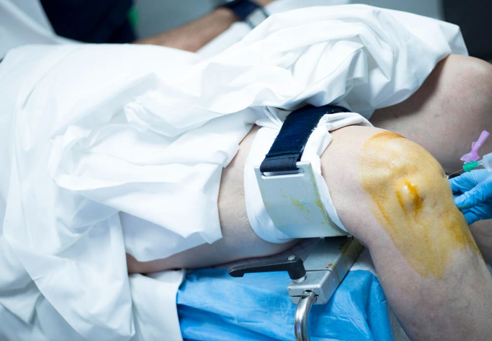 kobieta podczas operacji żylaków